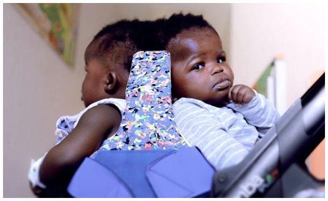 Afrikalı siyam ikizleri 18 saatlik operasyonla ayrıldı