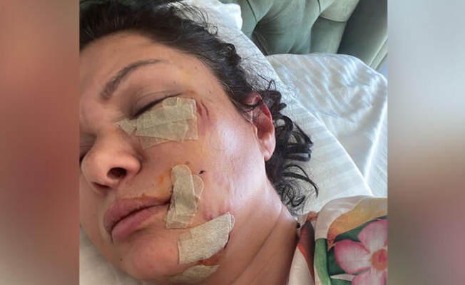 Şile'de köpek saldırısına uğrayan şarkıcı Tuğba Altıntop'un yüzüne dikiş atıldı